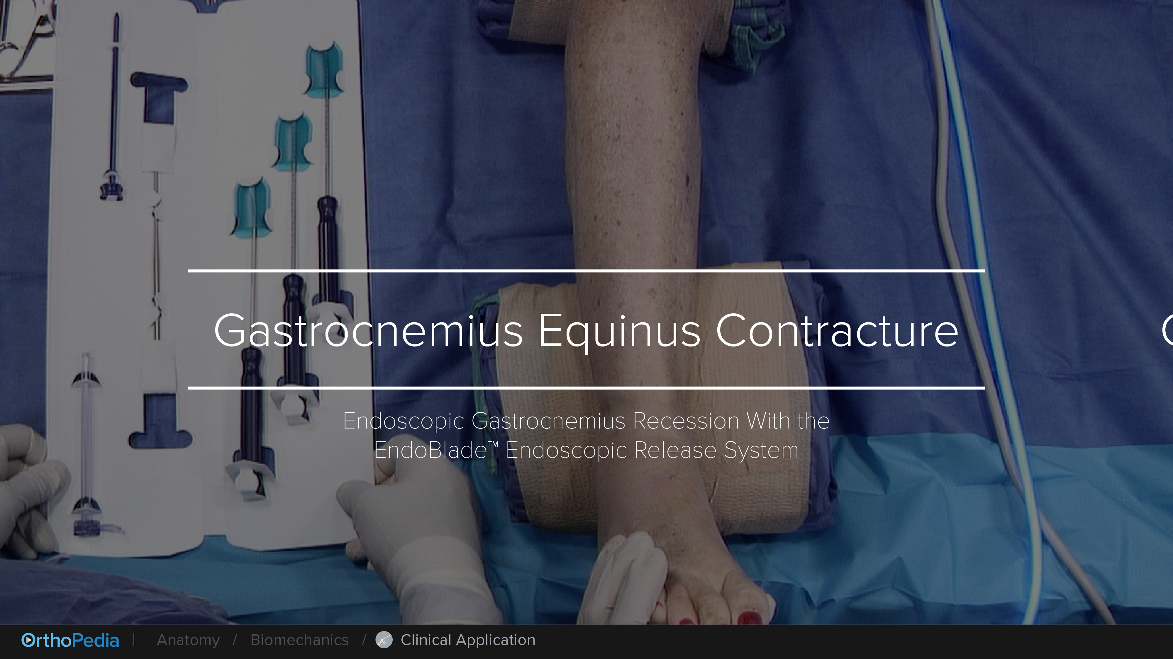 Gastrocnemius Equinus Contracture Endoscopic Gastrocnemius Recession
