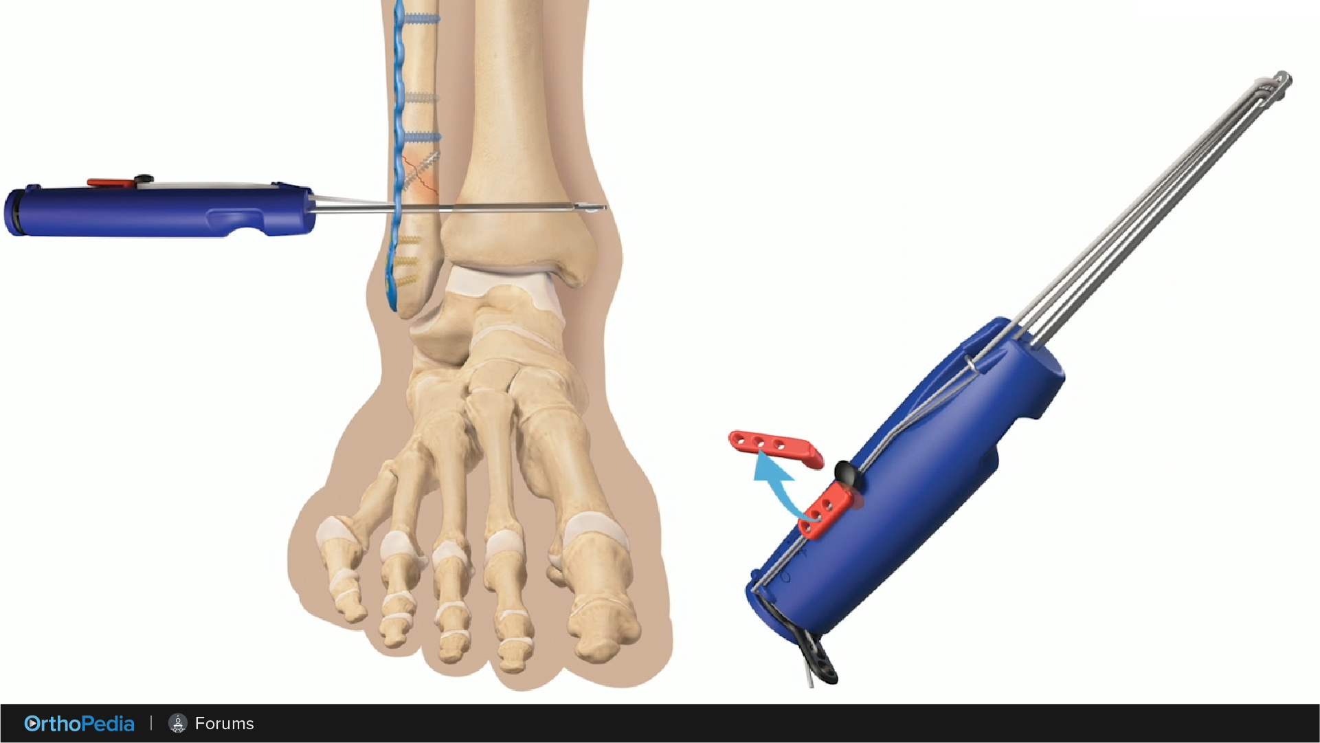 Ankle Fractures In 2020 Part 3 FibuLock Fibular Nail Technique With