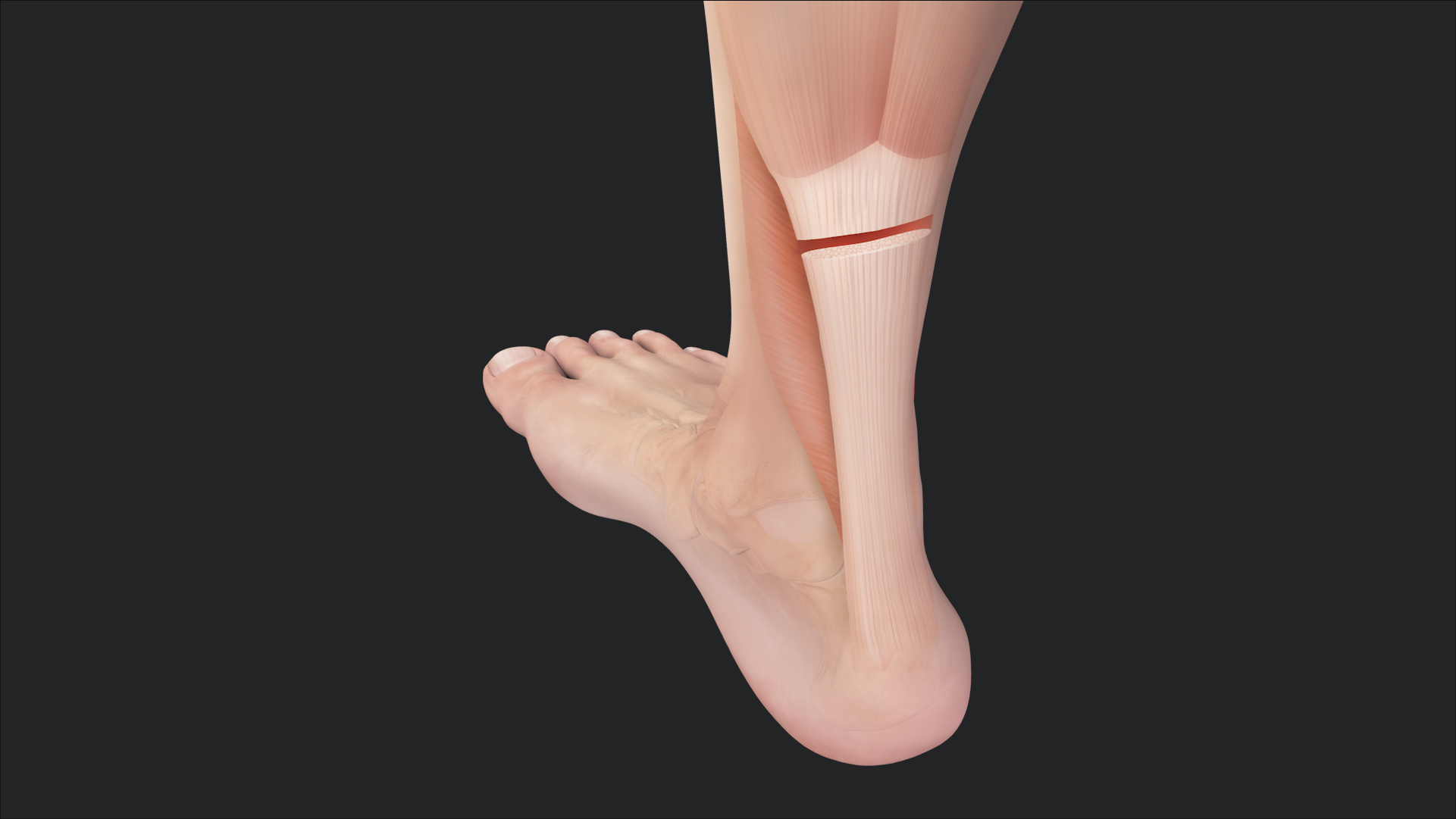 Gastrocnemius Equinus Contracture General Surgical Considerations