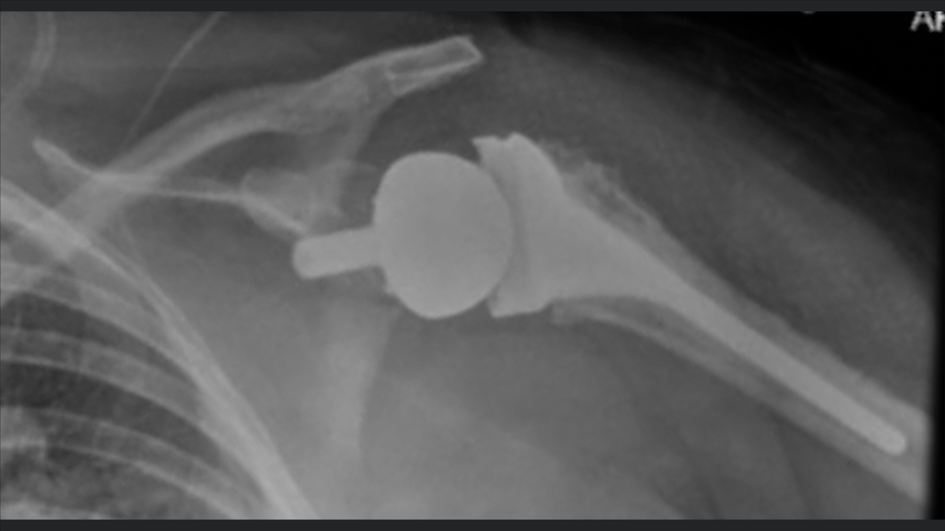 Dr. Werner Demonstrates Tips and Pearls for Glenohumeral Joint