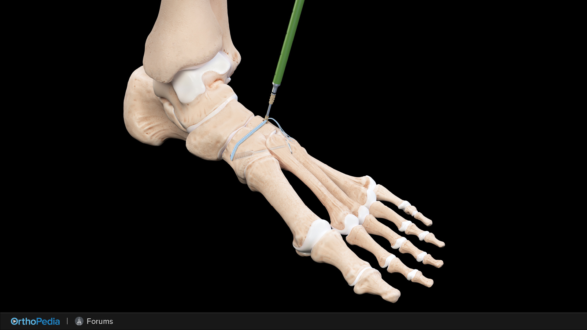 Foot and Ankle OTIF A Biomechanical Look Into Lisfranc Stabilization