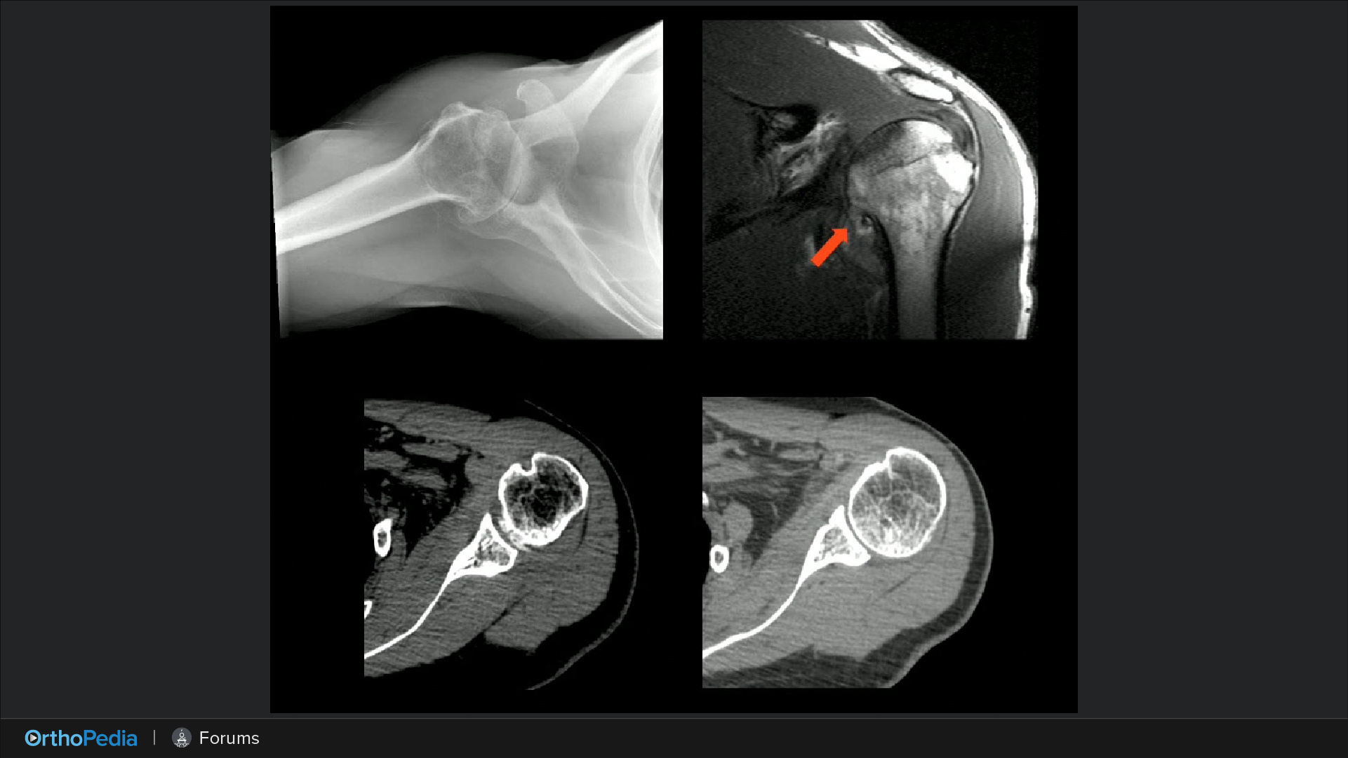 Arthroplasty OTIF Nonoperative Diagnosis, Assessment, and
