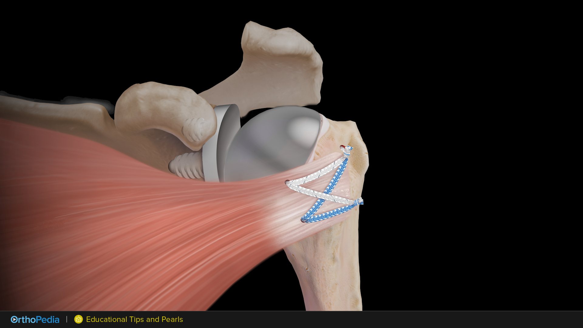 Dr. Werner Demonstrates Tips and Pearls for Glenohumeral Joint