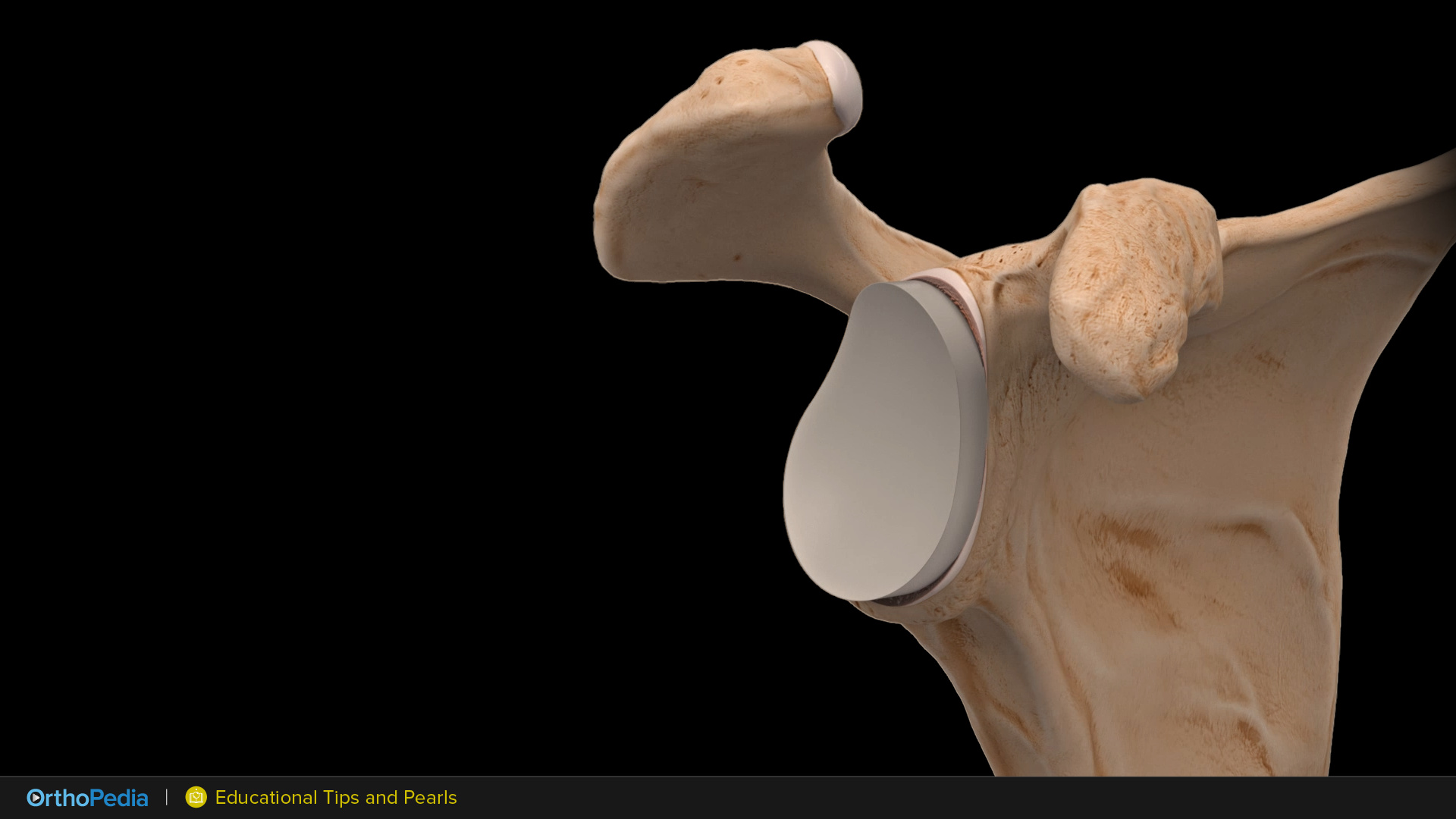 Dr. Gobezie Demonstrates Tips and Pearls for Glenohumeral Joint