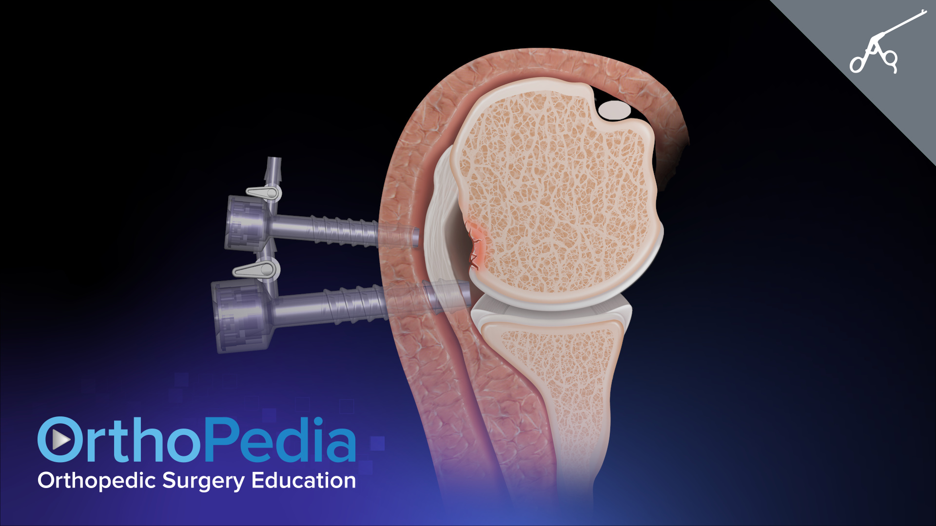 Anterior Glenohumeral Joint Instability AllInside Remplissage With